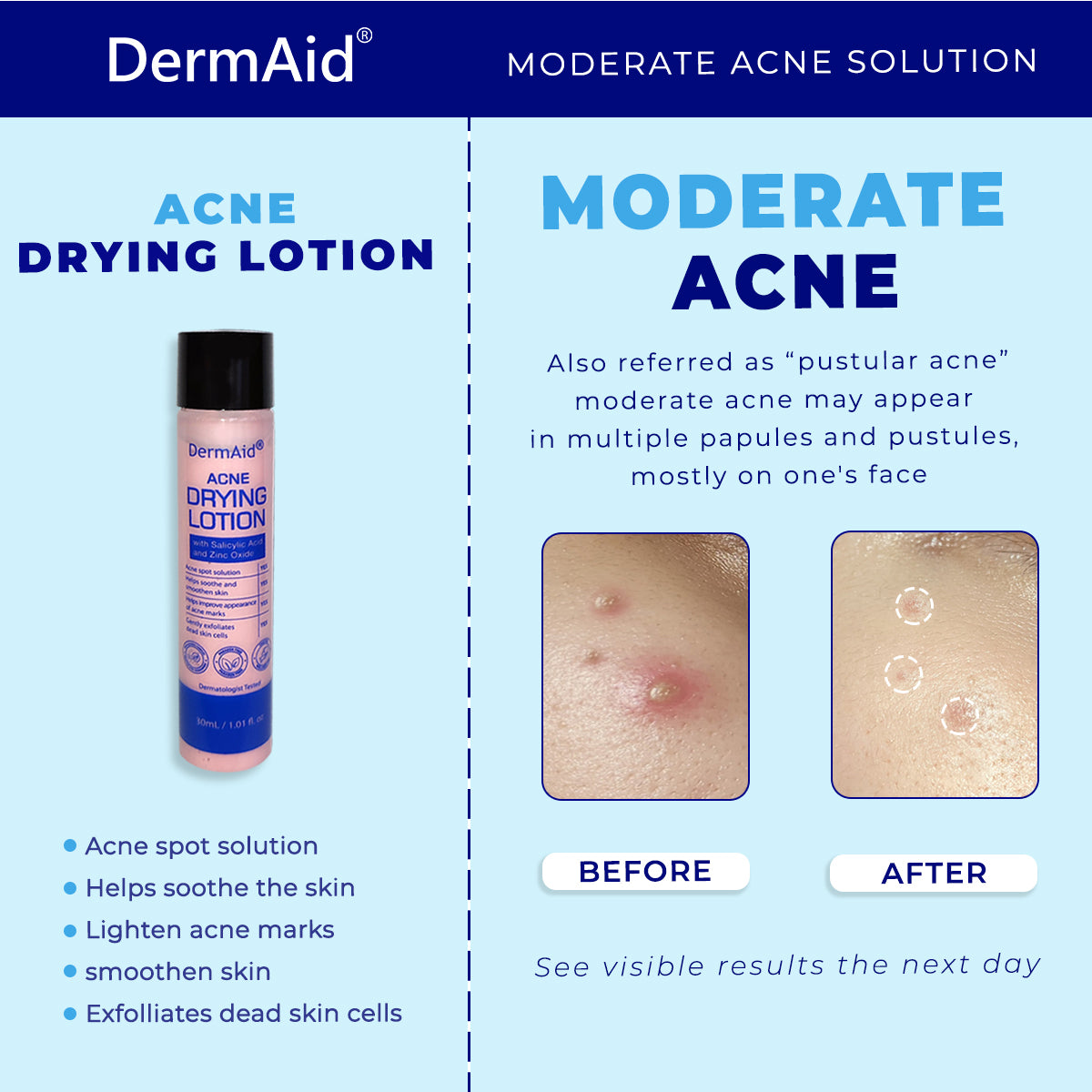 Dermaid Acne Drying Lotion 30ml